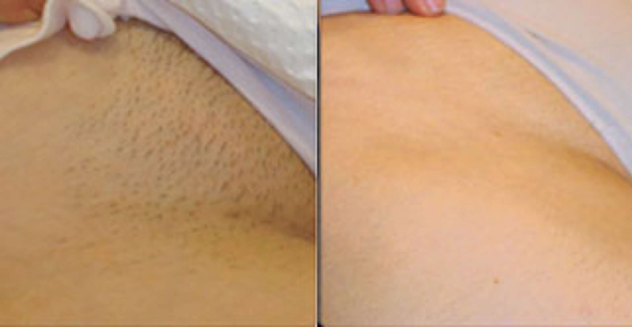 To acquire After and Before full brazilian wax picture trends Buy After and Before full brazilian wax picture trends