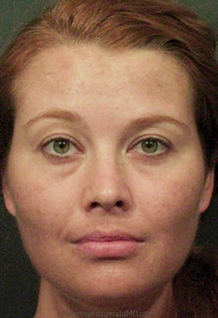 Sculptra butt injections in West Los Angeles Uncovered thumbnail