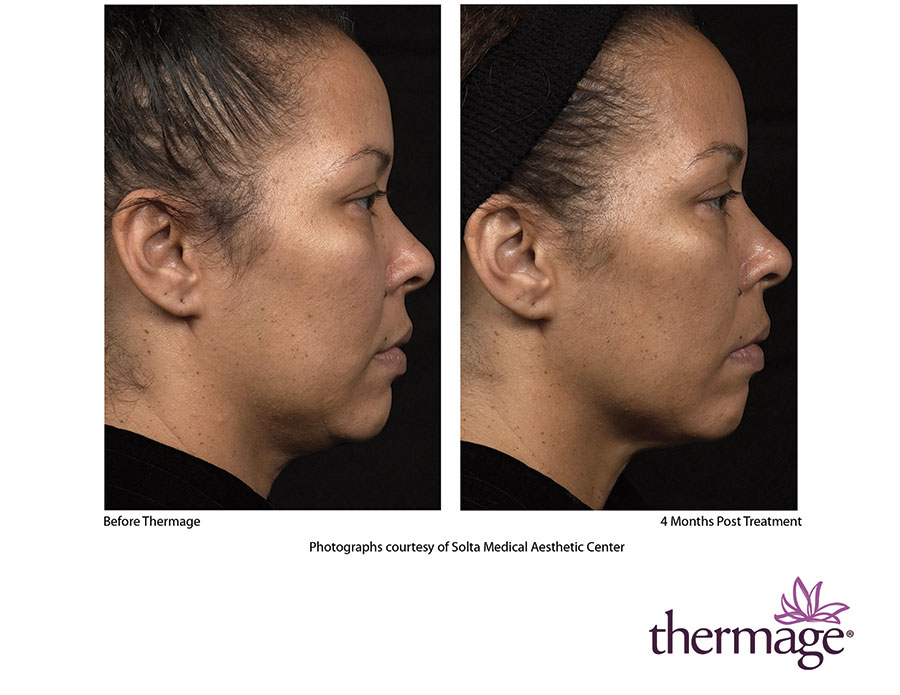 Thermage Treatments in LA | Advanced Non-Surgical Skin Tightening