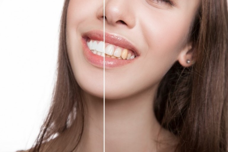 Alimentos que pueden dañar el esmalte de tus dientes