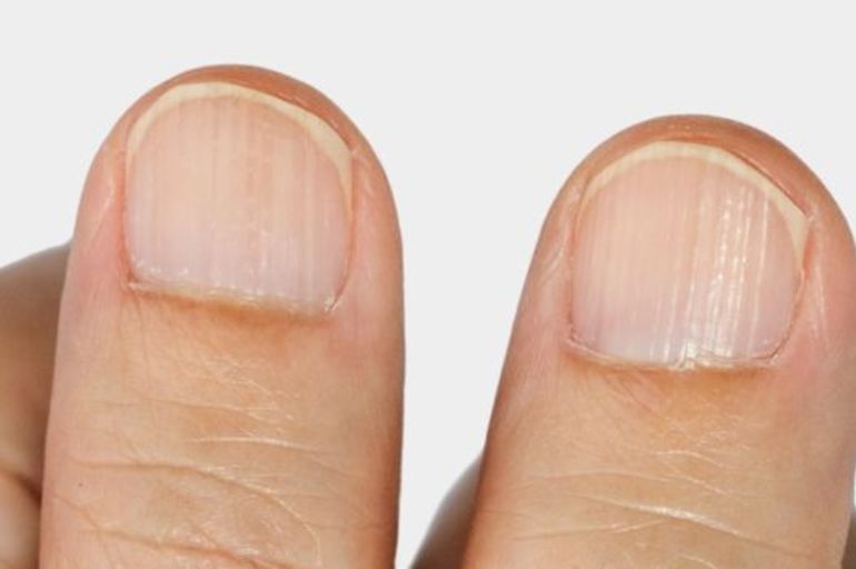 Frágiles, amarillentas o con manchas blancas: cuáles son las anomalías y problemas más frecuentes de las uñas.