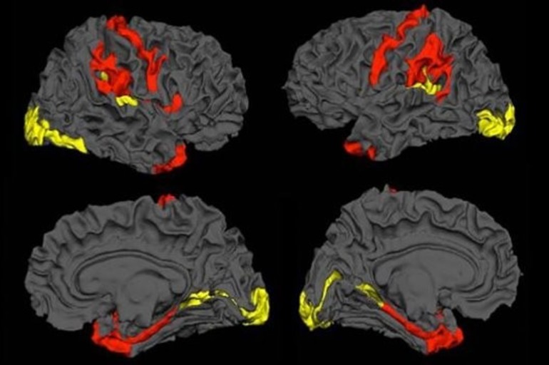 Los cerebros esquizofrénicos tienen la capacidad de regenerarse