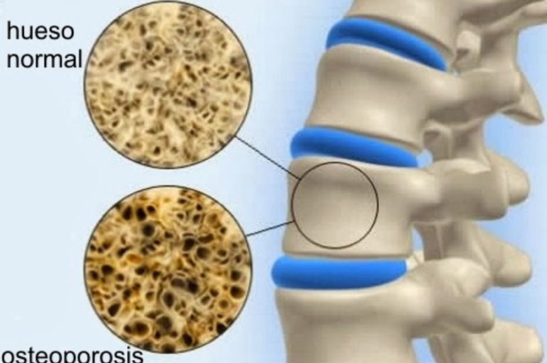 La osteoporosis y el tratamiento con cannabis