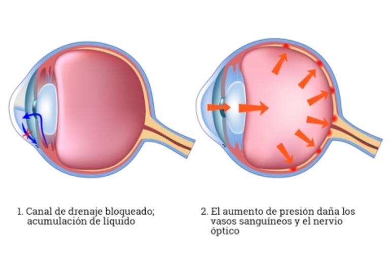 Medicinas Alternativas para el Manejo del Glaucoma