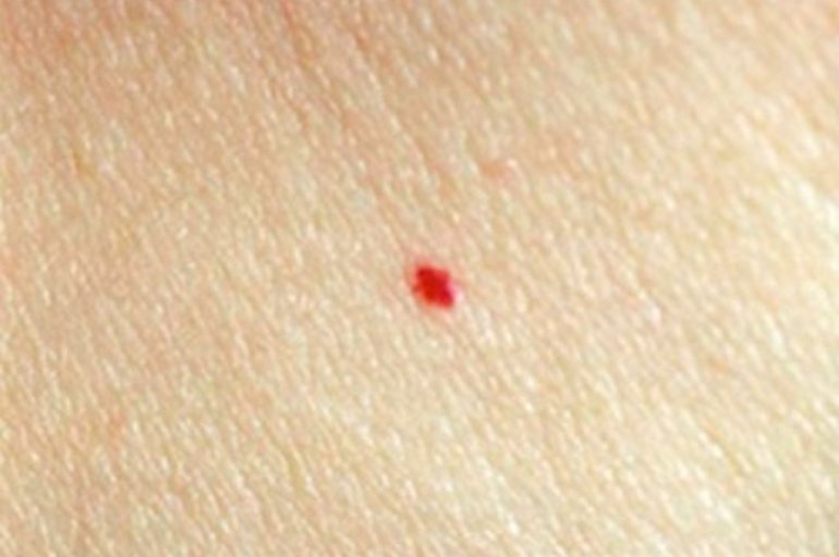 ¿Qué significan los puntos rojos que salen en la piel?