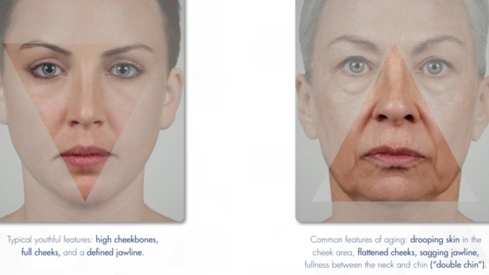 Dr. Bindiya - Chiseled jawline? Yes, please! As we age the face grows  forward and starts to sag. We've started to see a lot of younger women  among the older women concerned
